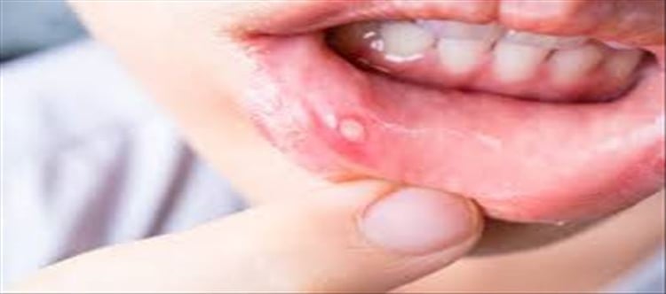 how-to-treat-mouth-ulcer-at-home