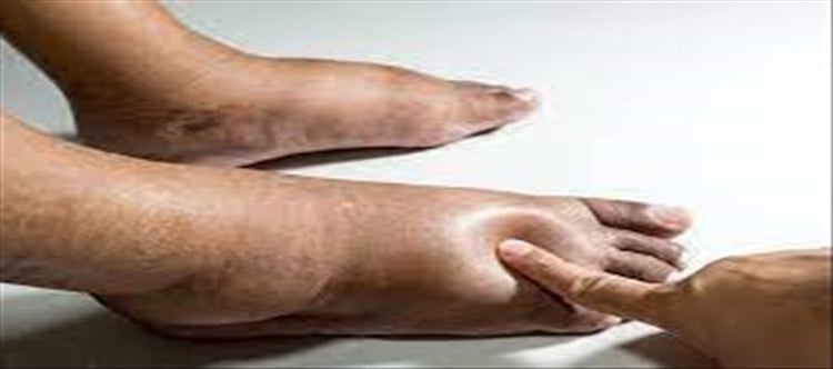 Swelling in legs..? These diseases may be the reason..