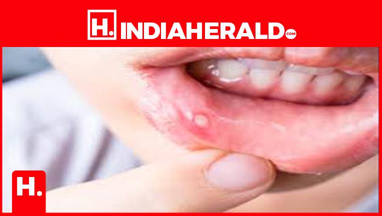 how-to-treat-mouth-ulcer-at-home