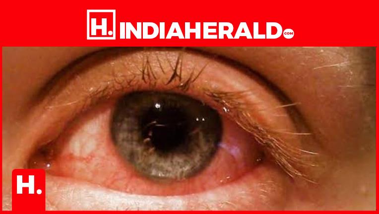 Madras Eye Tips For Treatment And Prevention 1053
