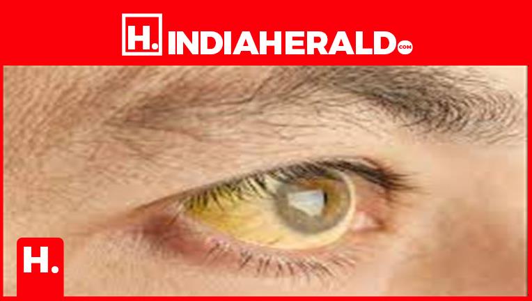 what-do-yellow-or-red-eyes-say-about-your-health