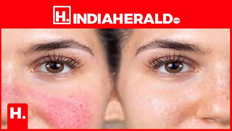 red-marks-on-the-face-is-a-sign-of-serious-illness